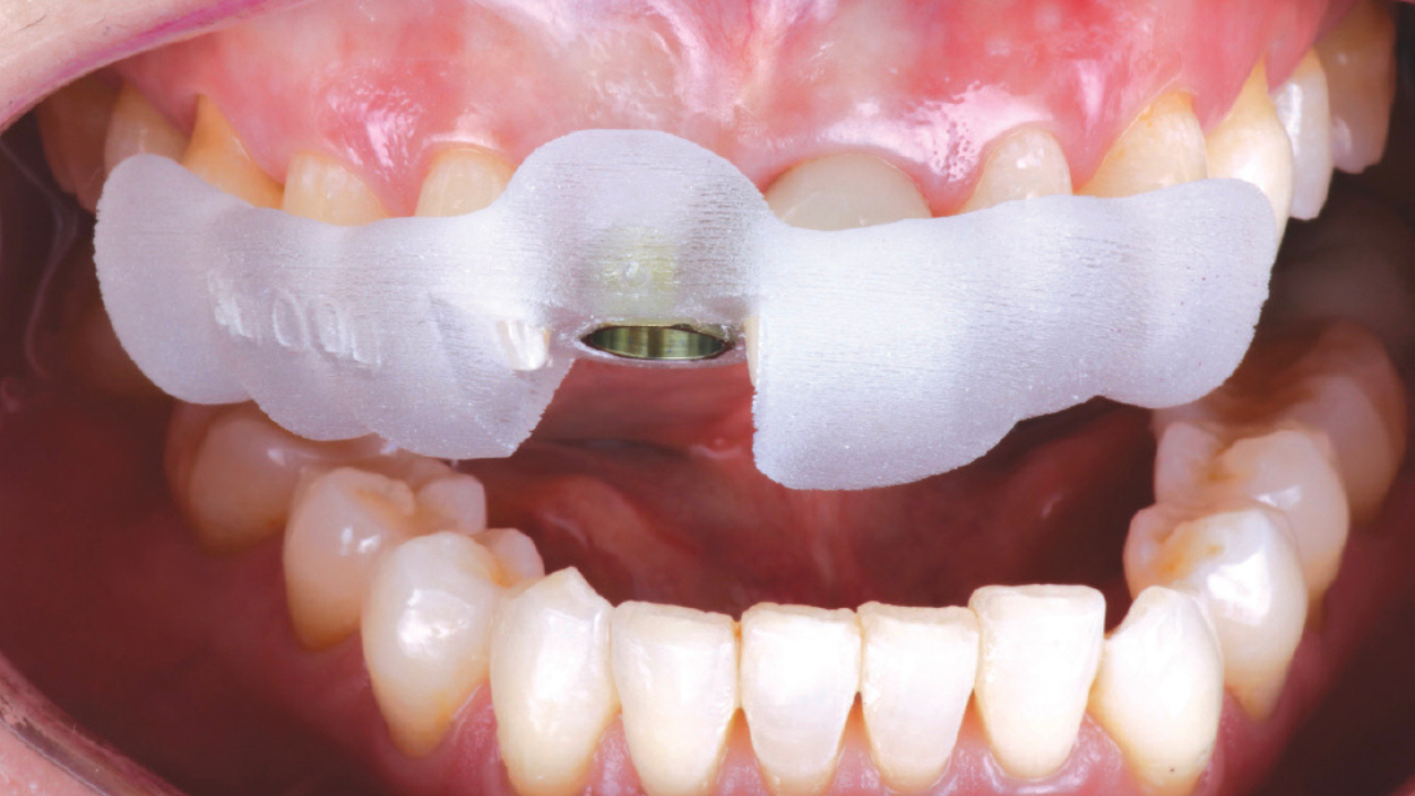Replacing a Front Tooth With Guided Implant Dentistry: A Precise, Modern Approach