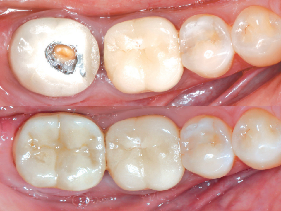 Single-Day Crowns: How Modern Dentistry Restores Your Tooth in One Visit 