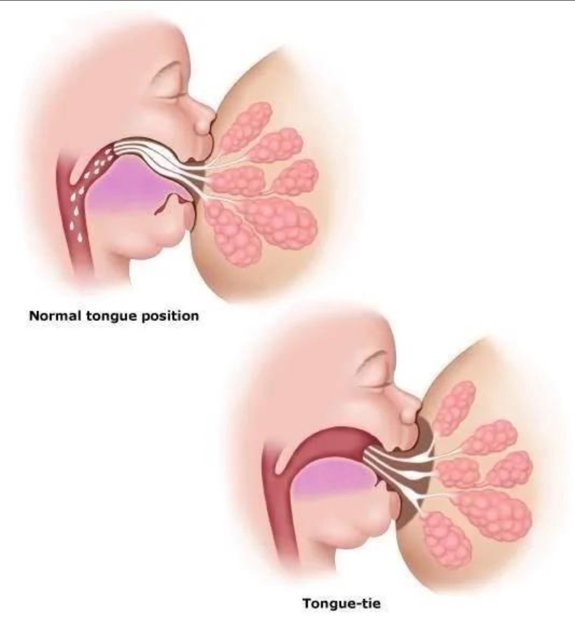 Illustration comparing tongue movement during breastfeeding with and without tongue-tie