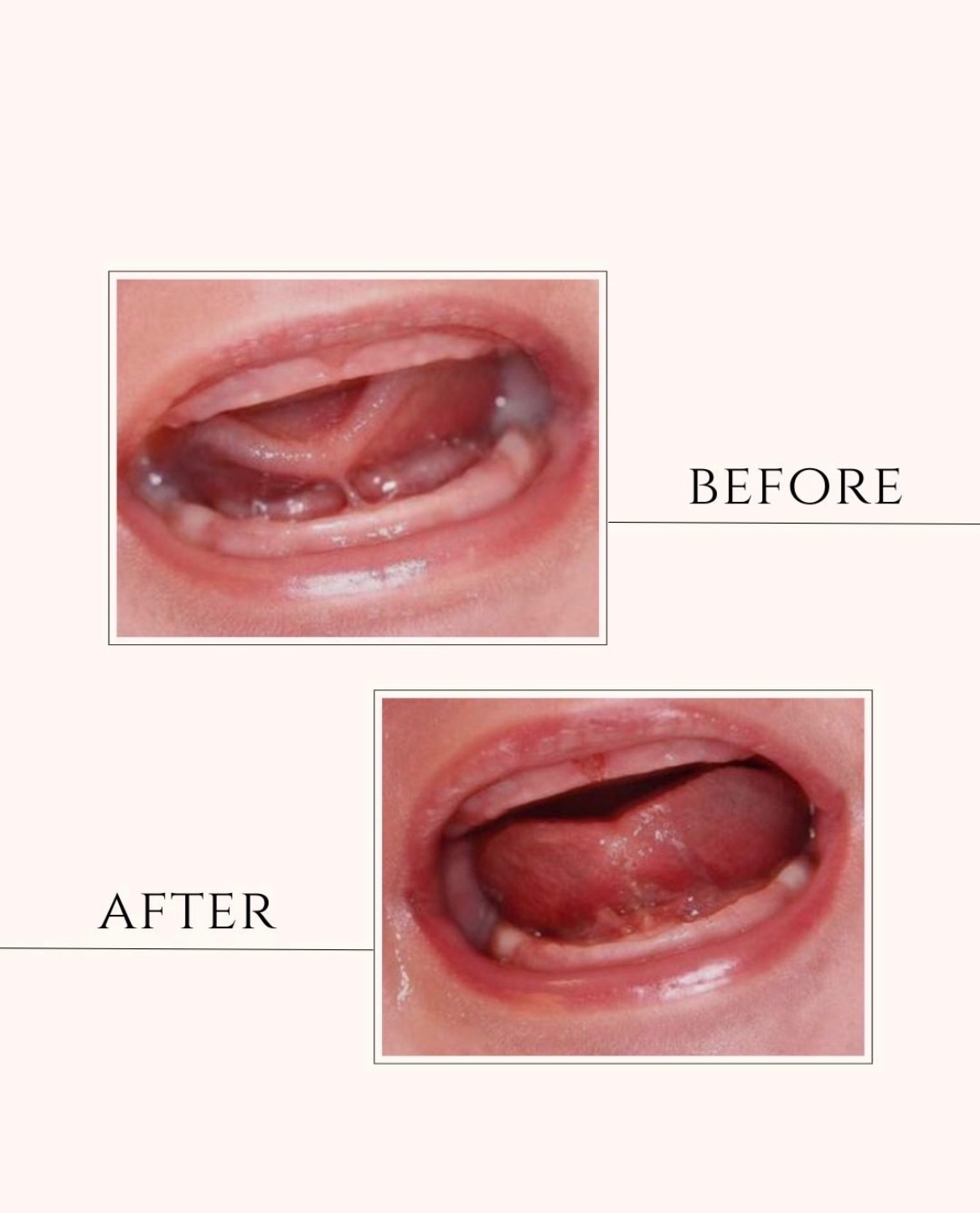 Before-and-after photos of tongue-tie release