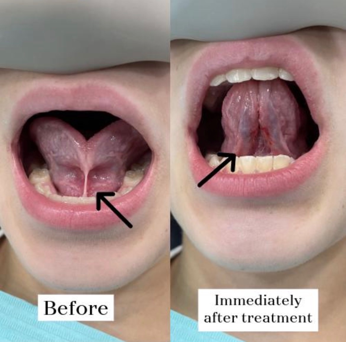 Tongue position before and immediately after tongue-tie treatment