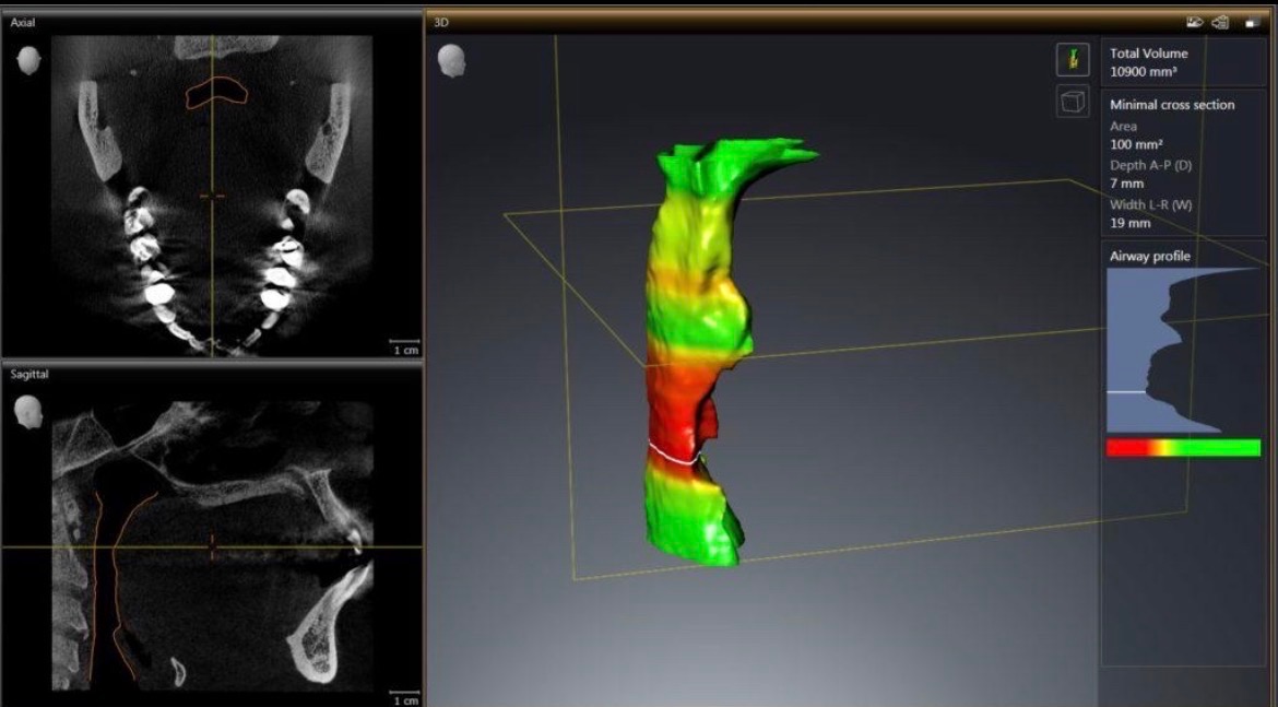 Airway scan with a three-dimensional model and cross-sectional views