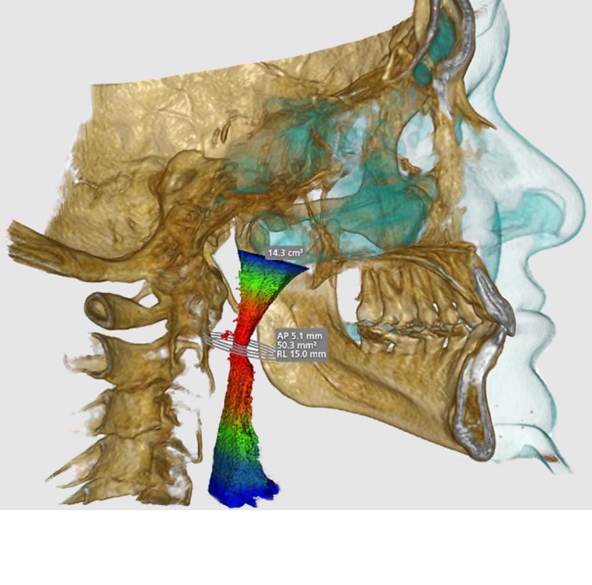 Three-dimensional scan showing the airway beside the skull and jaw