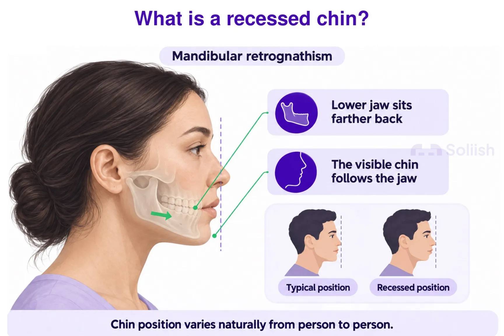 what is a recessed chin