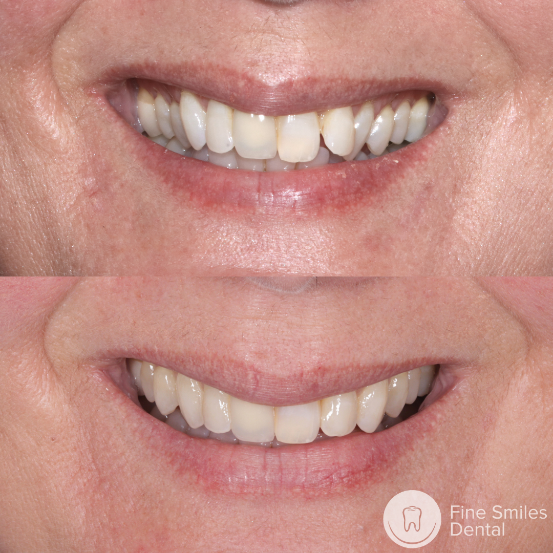 Invisalign Before and After 