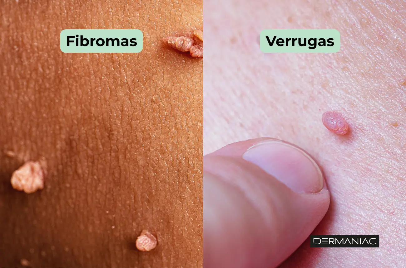verrugas vs fibromas cutáneos