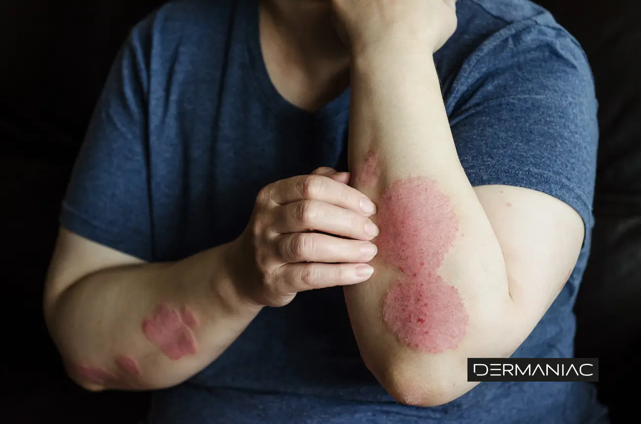 que es la psoriasis y que tipos hay