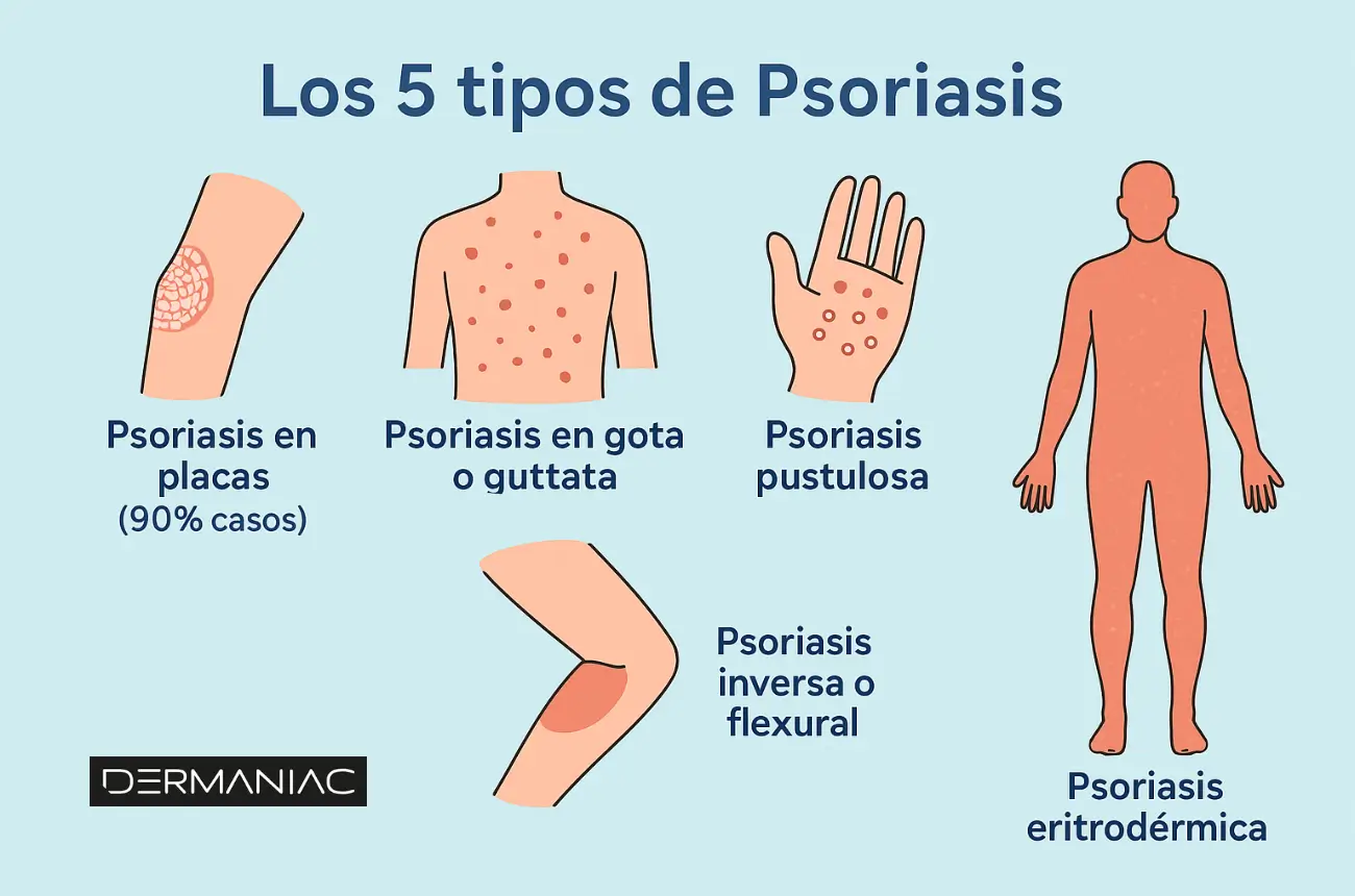 tipos de psoriasis infografías