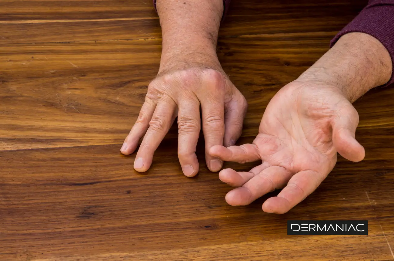 manos de una persona con artritis psoriásica
