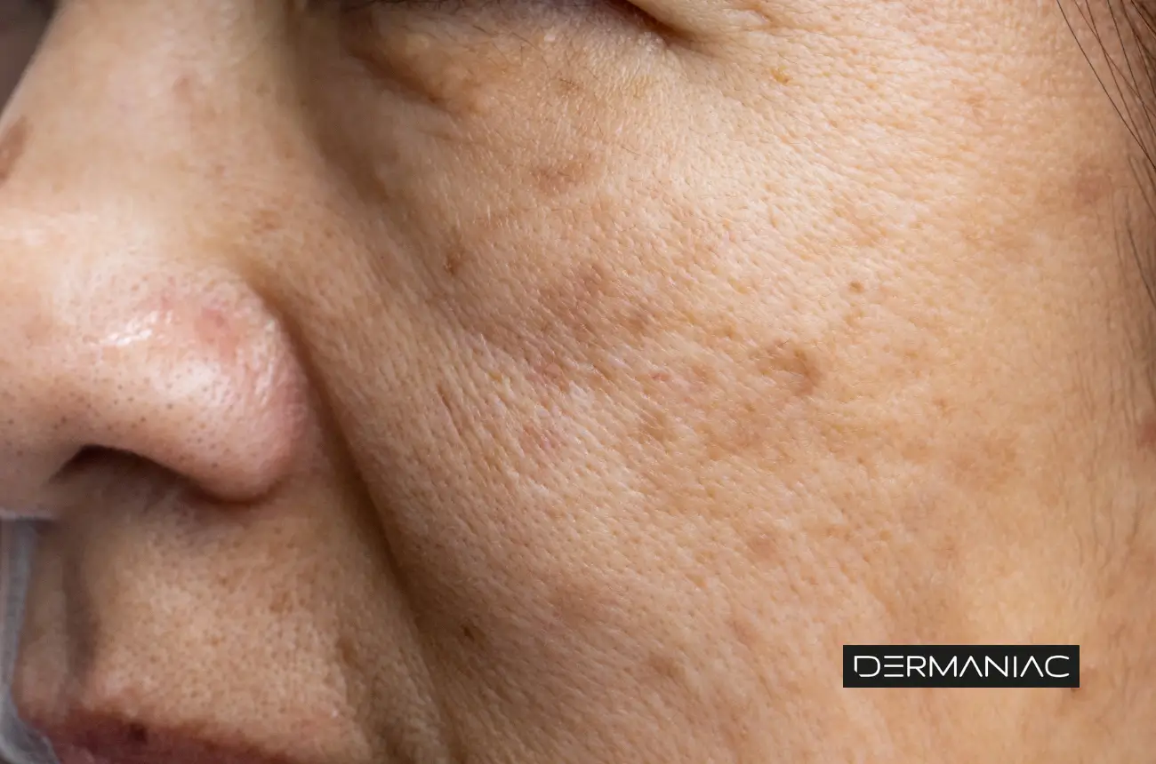 melasma y léntigo solar