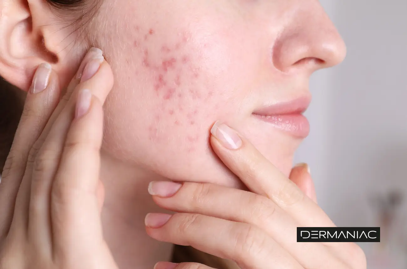 eliminar-cicatrices-de-acne