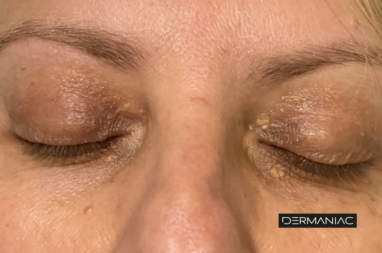 Paciente de Dermaniac con xantelasma