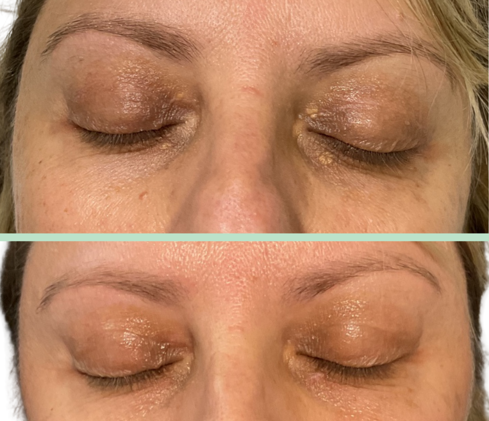 Antes y después de correciónd e xantelasmas con Láser de CO2 en Dermaniac