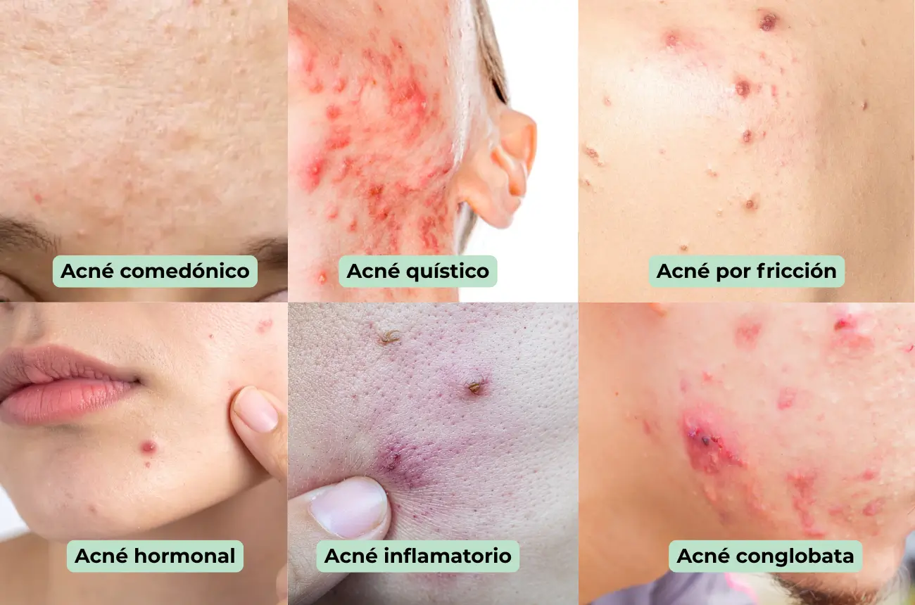imágenes de ejemplo de los diferentes tipos de acné