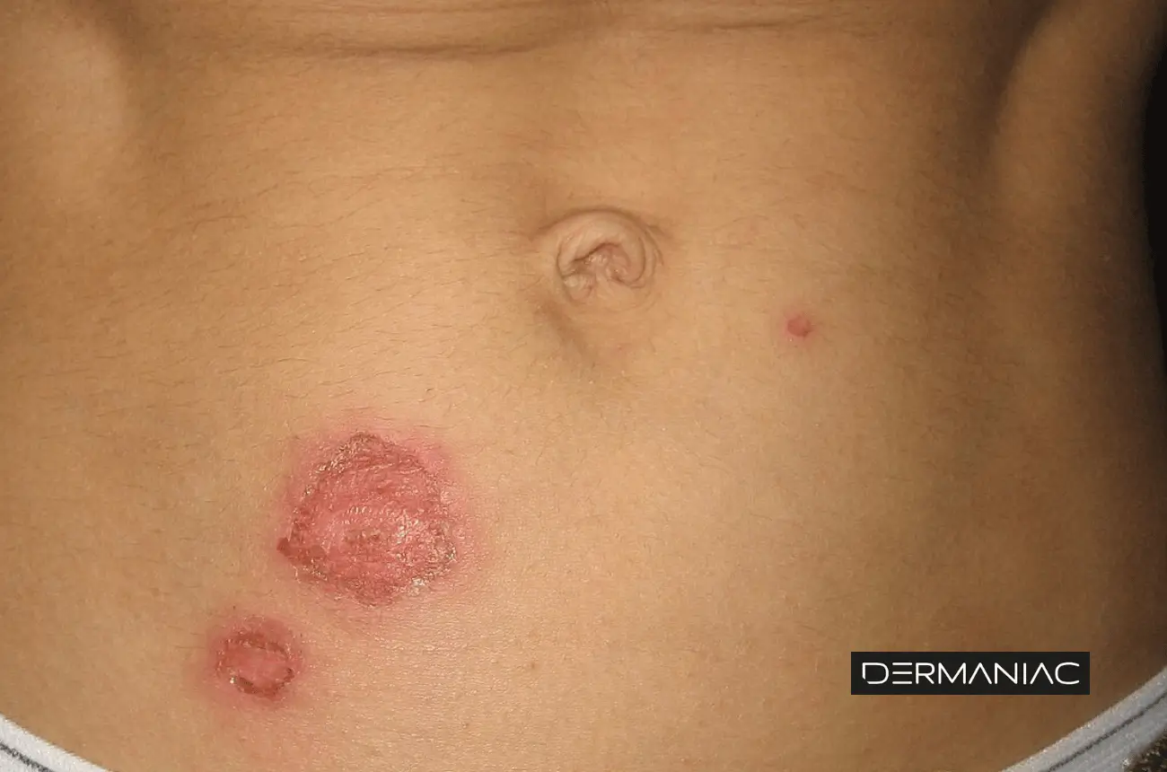 Ampollas causadas por el impétigo ampolloso