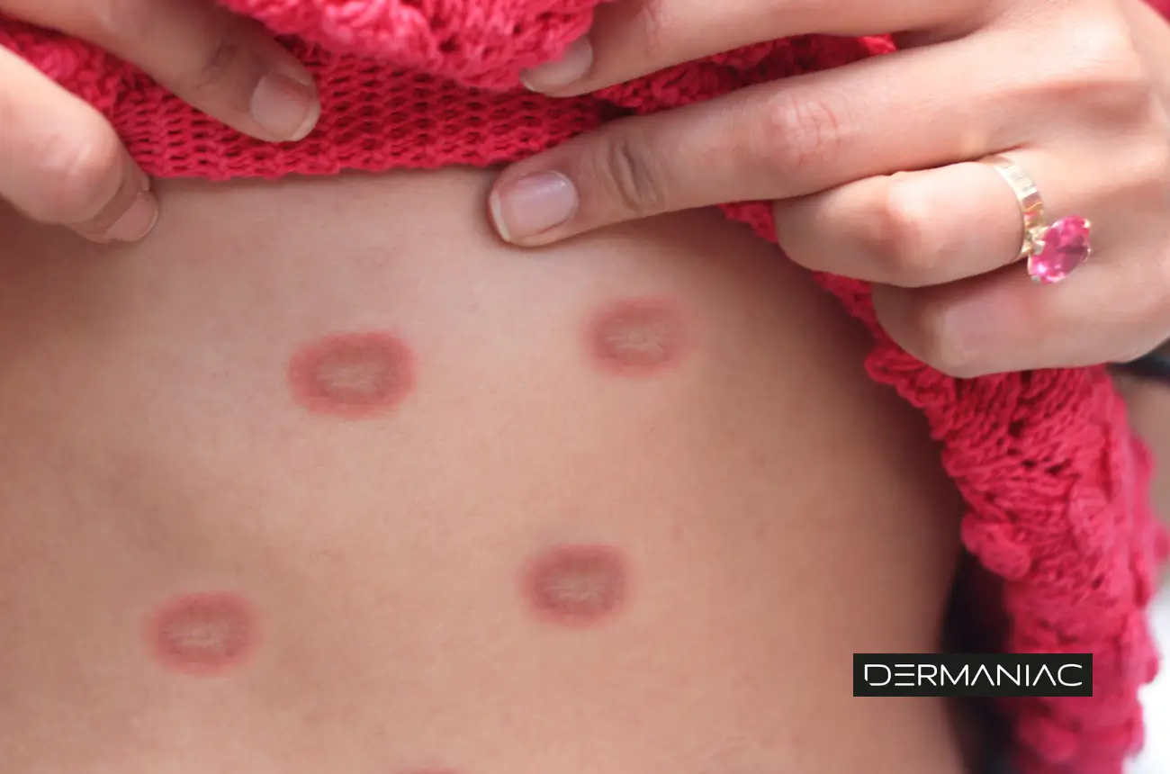 eritema multiforme en abdomen de una mujer