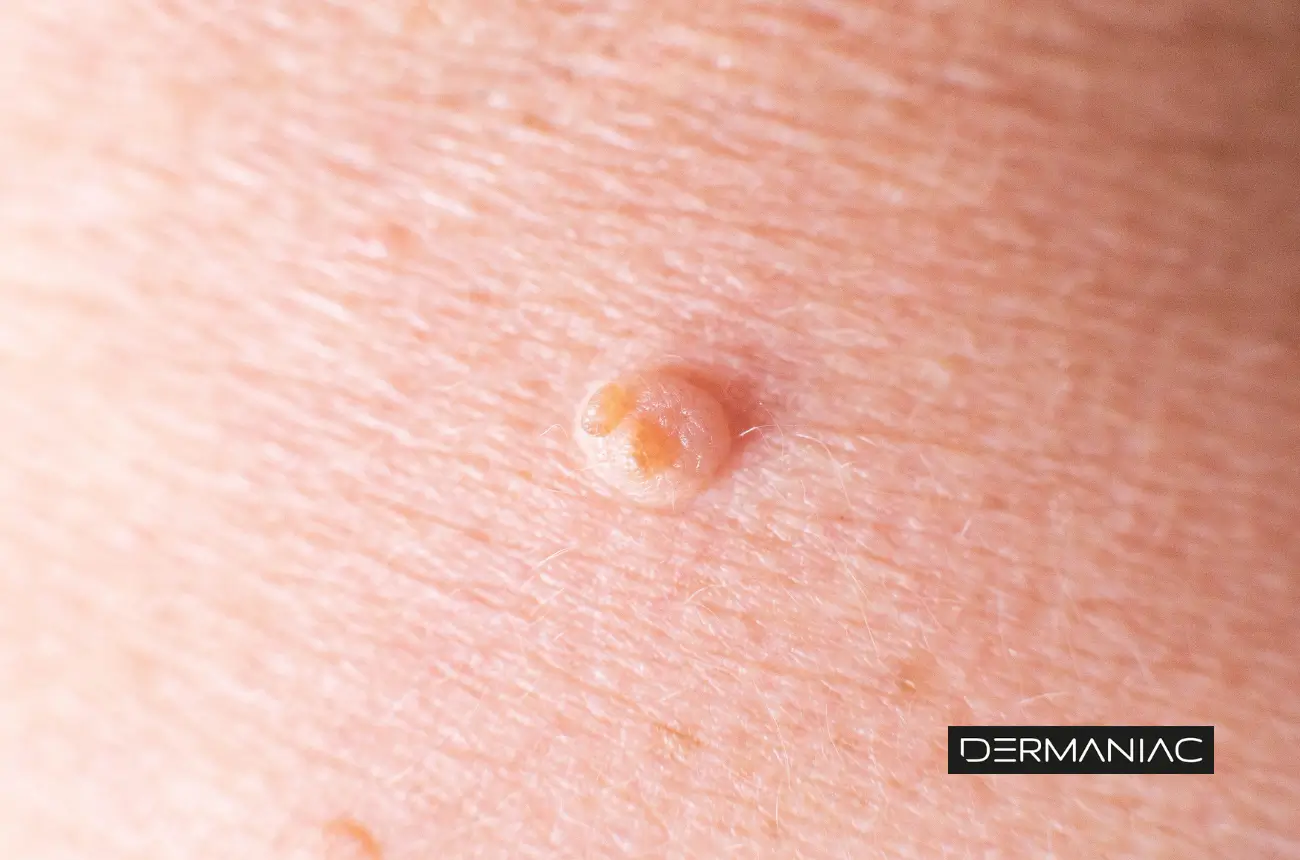 Fibromas (skin tags) y verrugas víricas