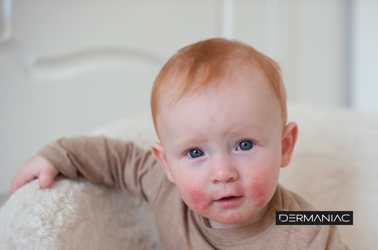 Dermatitis perioral
