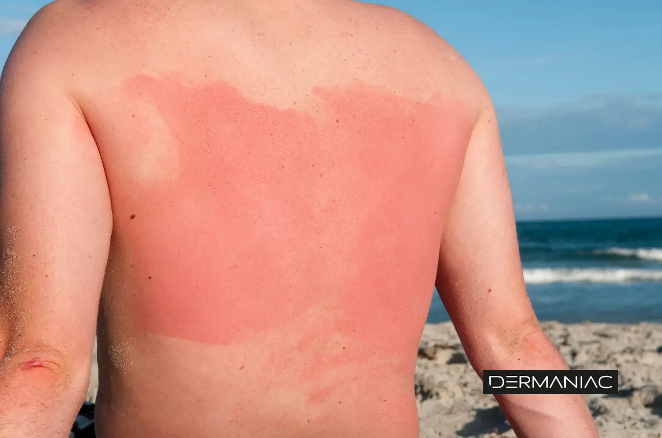 Persona con sñintomas de alergia al sol