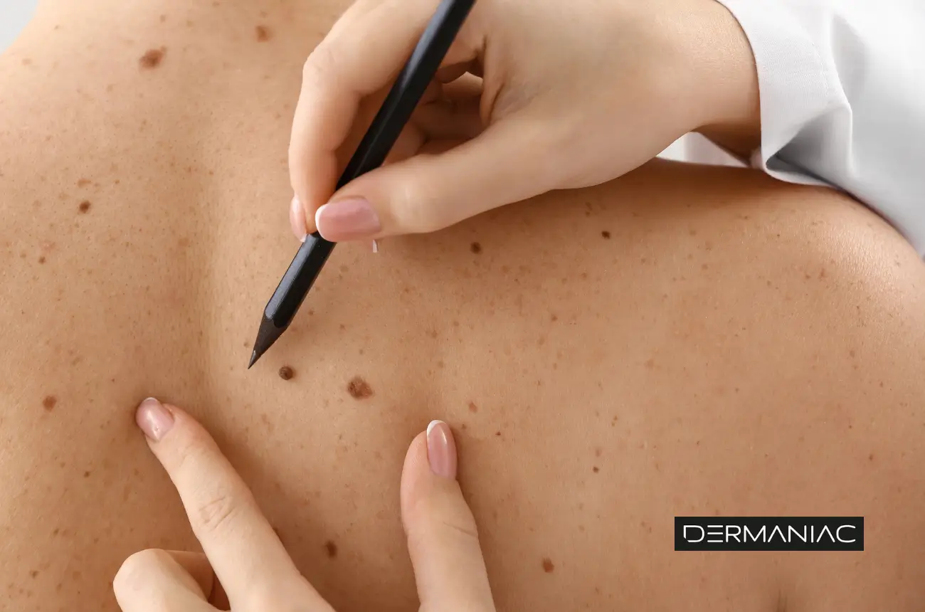 Lunares y melanomas