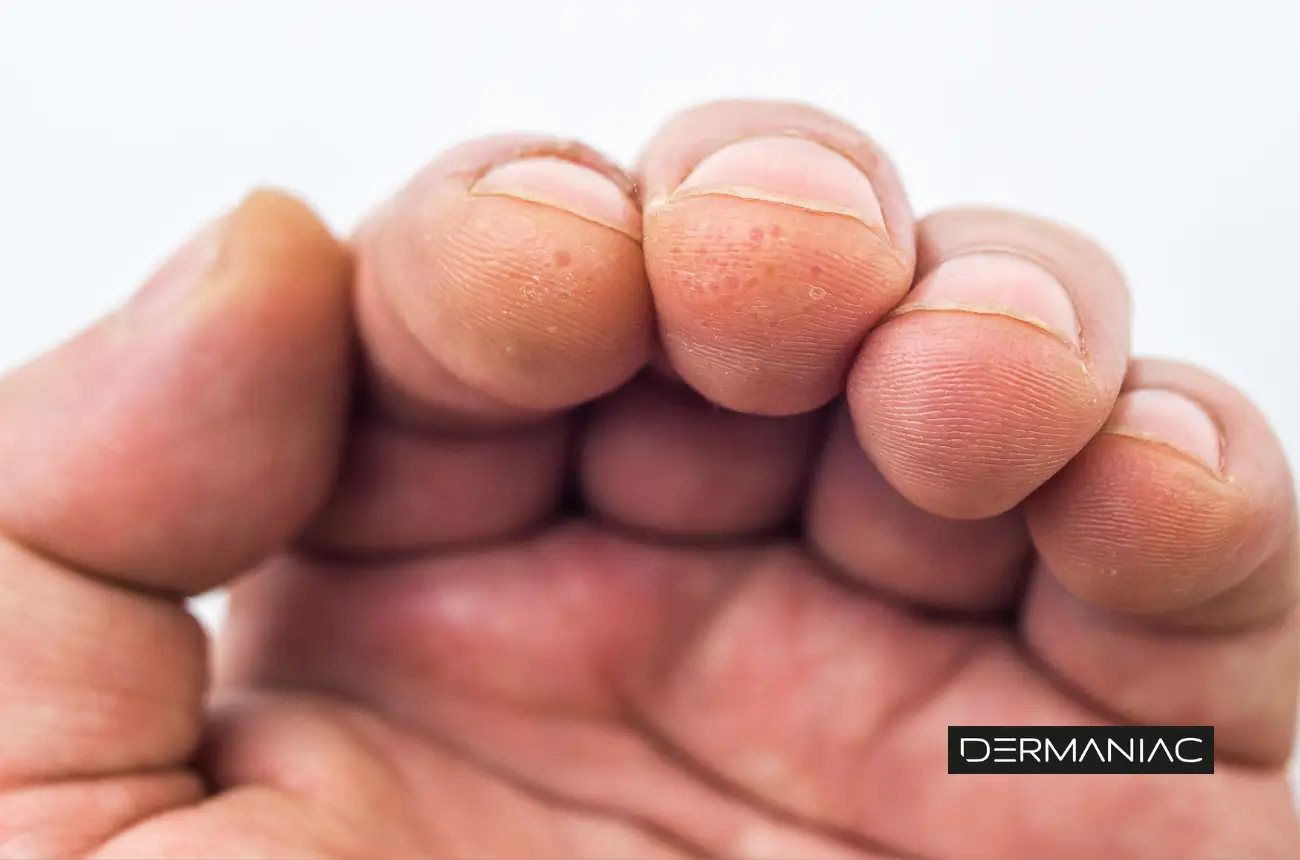 Mano con Dishidrosis