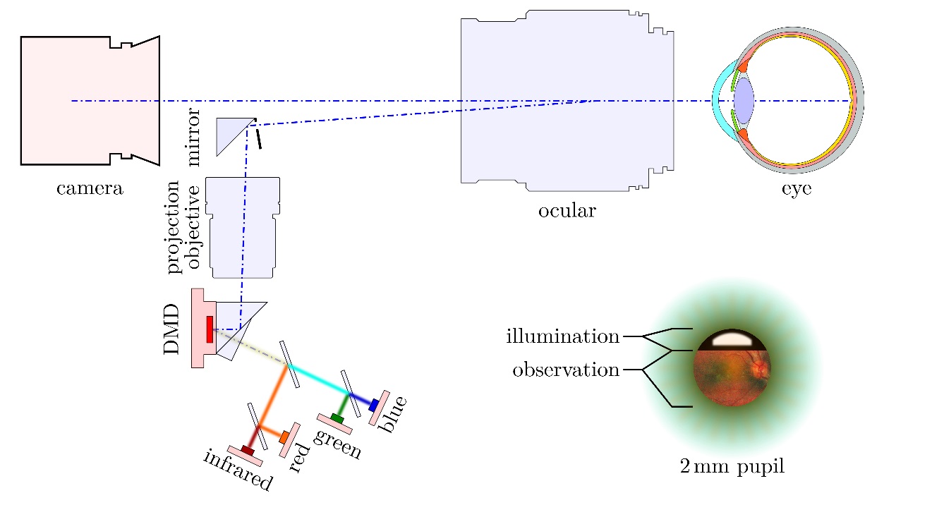 Illustration of a DMD that is integrated in the illumination path and projected onto the retina.