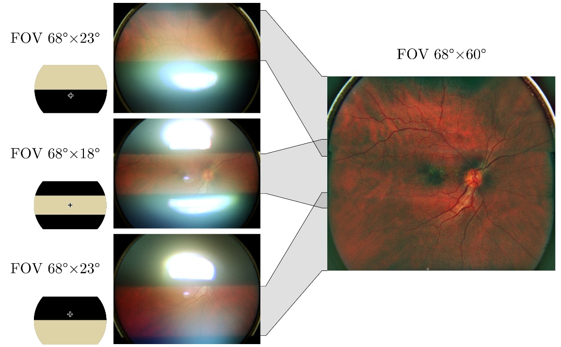 A picture of a retina that has been captured by three shots through a pupil.