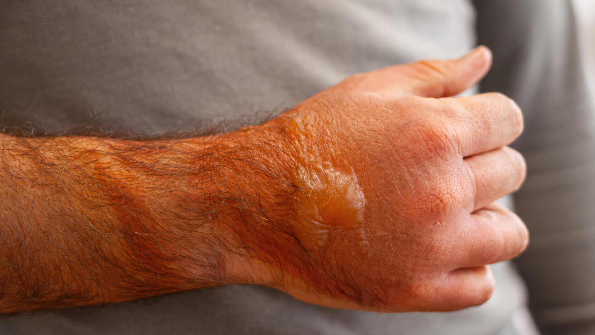 Burned at Work or in Public? When to Call a Burn Injury Lawyer