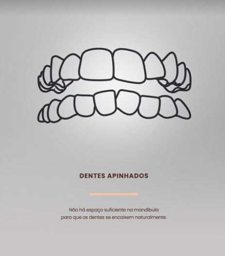 dentes apinhados