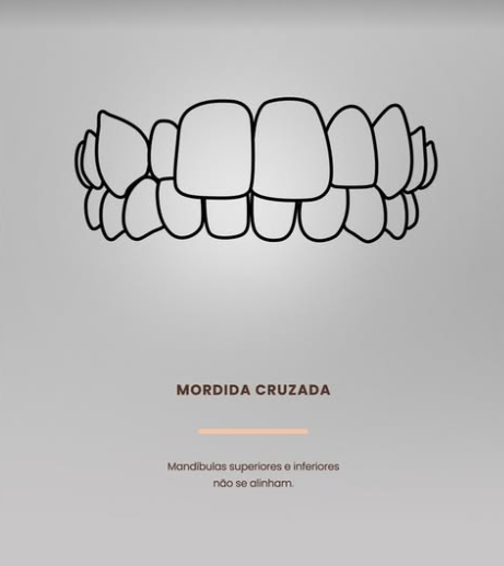mordida cruzada