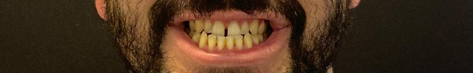 Antes do tratamento Invisalign