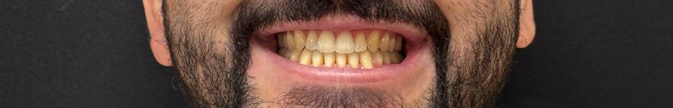 Depois do tratamento Invisalign