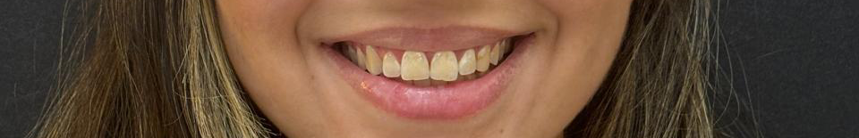 Antes do tratamento Invisalign