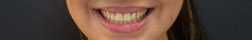 Depois do tratamento Invisalign
