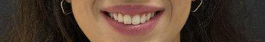 Antes do tratamento Invisalign