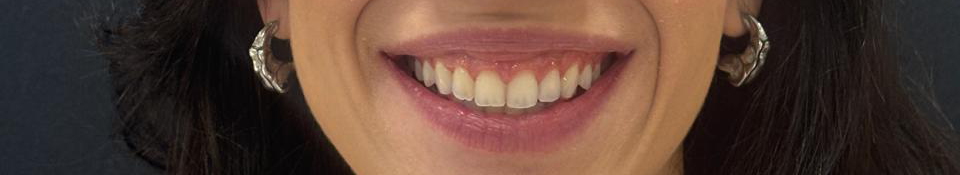 Depois do tratamento Invisalign