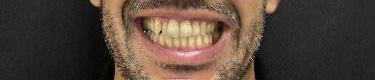 Antes do tratamento Invisalign