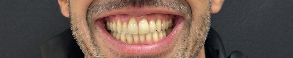 Depois do tratamento Invisalign
