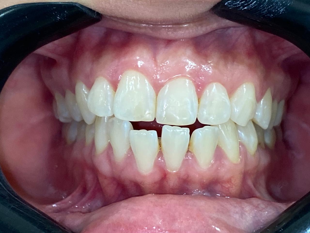 Antes do tratamento Invisalign