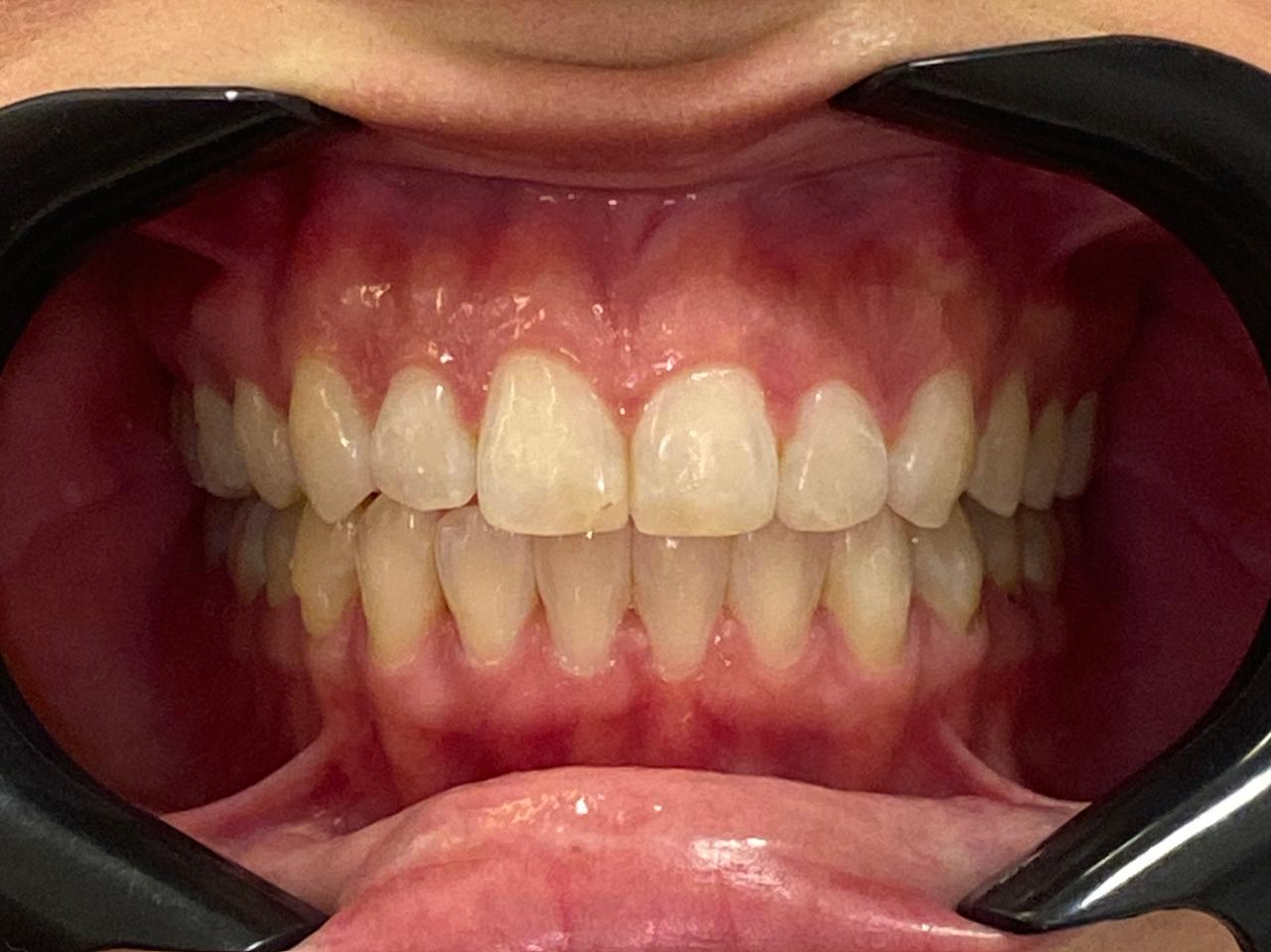 Depois do tratamento Invisalign