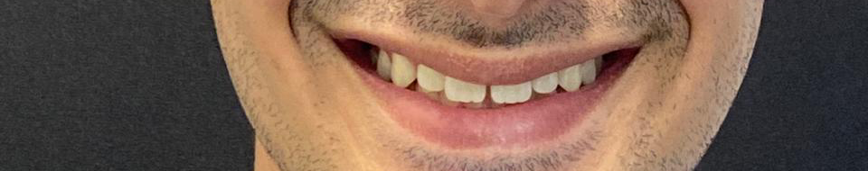 Antes do tratamento Invisalign