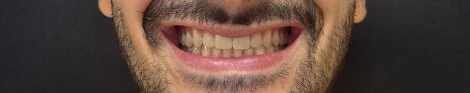 Depois do tratamento Invisalign