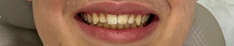 Antes do tratamento Invisalign
