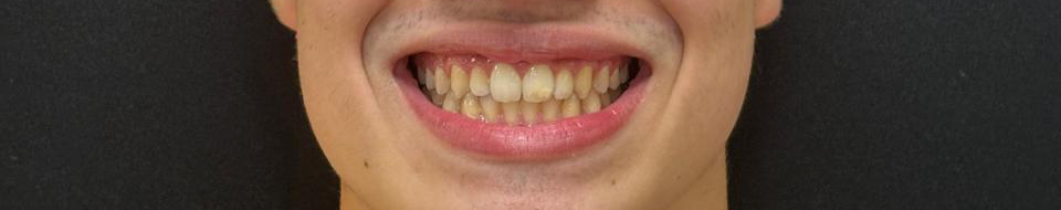 Depois do tratamento Invisalign