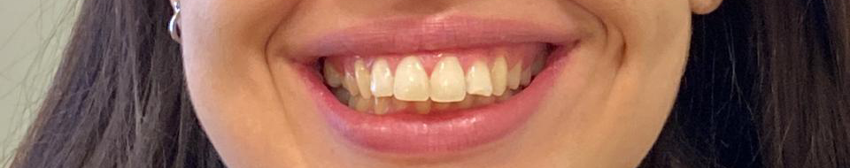Antes do tratamento Invisalign