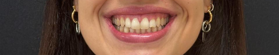 Depois do tratamento Invisalign