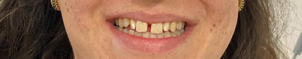 Antes do tratamento Invisalign