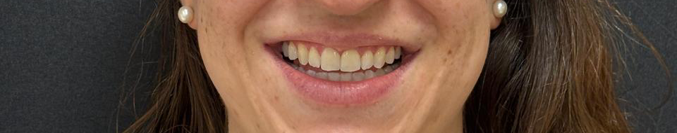 Depois do tratamento Invisalign