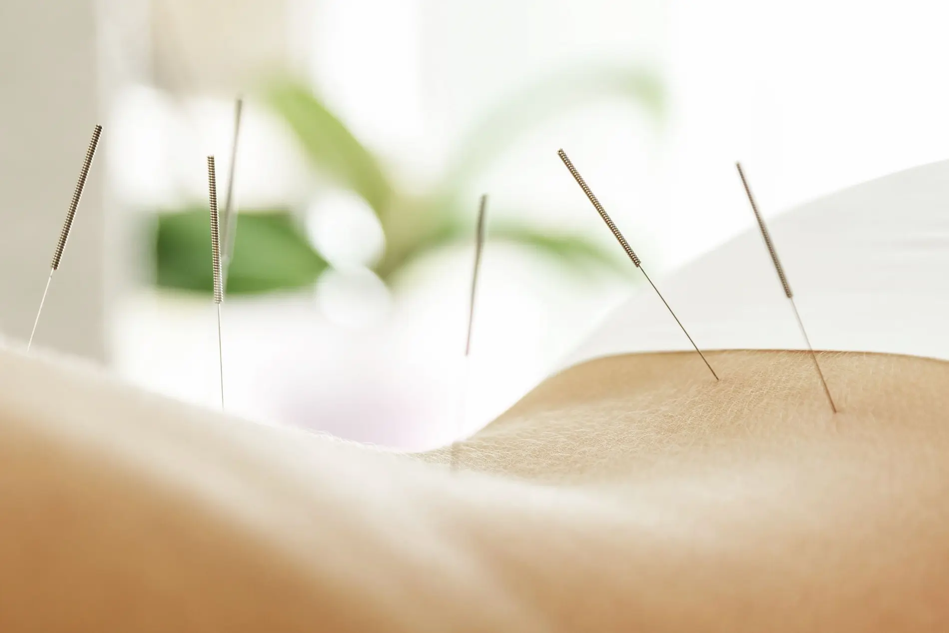 Acupuncture for Back Pain: What the Evidence Shows