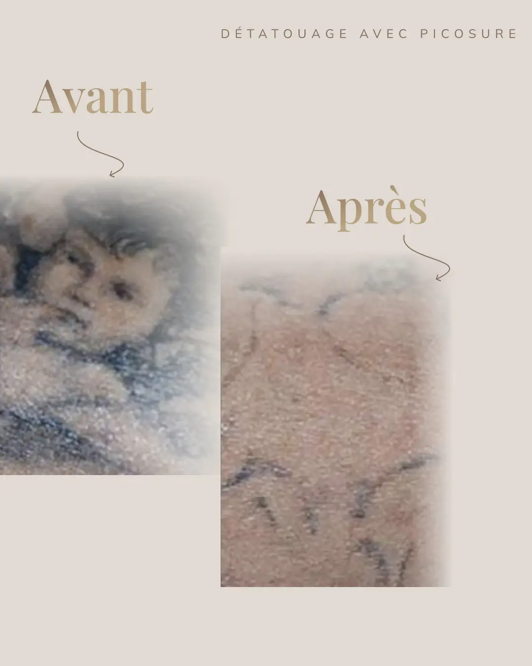 Une image avant après d'un détatouage d'un tattoo avec encre noir réalisé par la technologie picosure pro à la clinique dermamédibeauté situé à Laval.